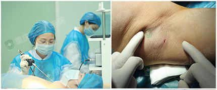 1分钟看懂腋臭手术全过程【图文】_重庆三一八【官网】 治疗腋臭狐臭